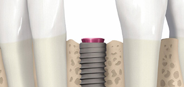 Dentale Implantate in München